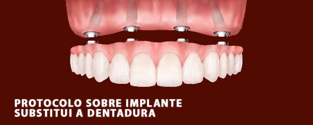 Protocolo sobre implante - Centro de Cirurgia Oral