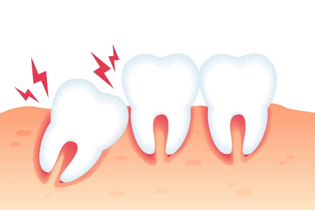 Ilustração simplificada mostrando uma fileira de dentes na gengiva, com um dente de siso inclinado e parcialmente erupcionado, tocando o dente adjacente.