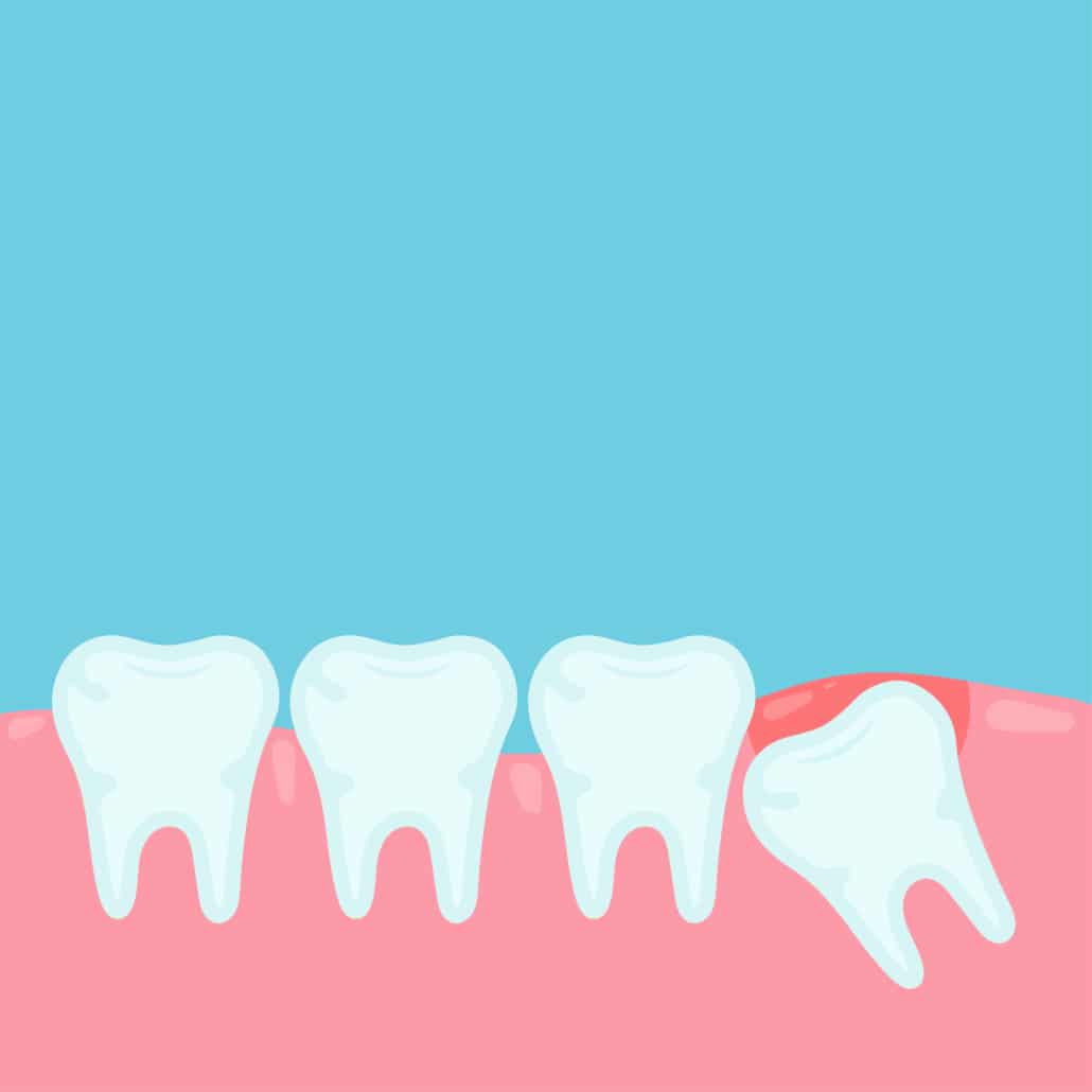 Ilustração simplificada mostrando uma fileira de dentes na gengiva, com um dente de siso inclinado e parcialmente erupcionado, tocando o dente adjacente.