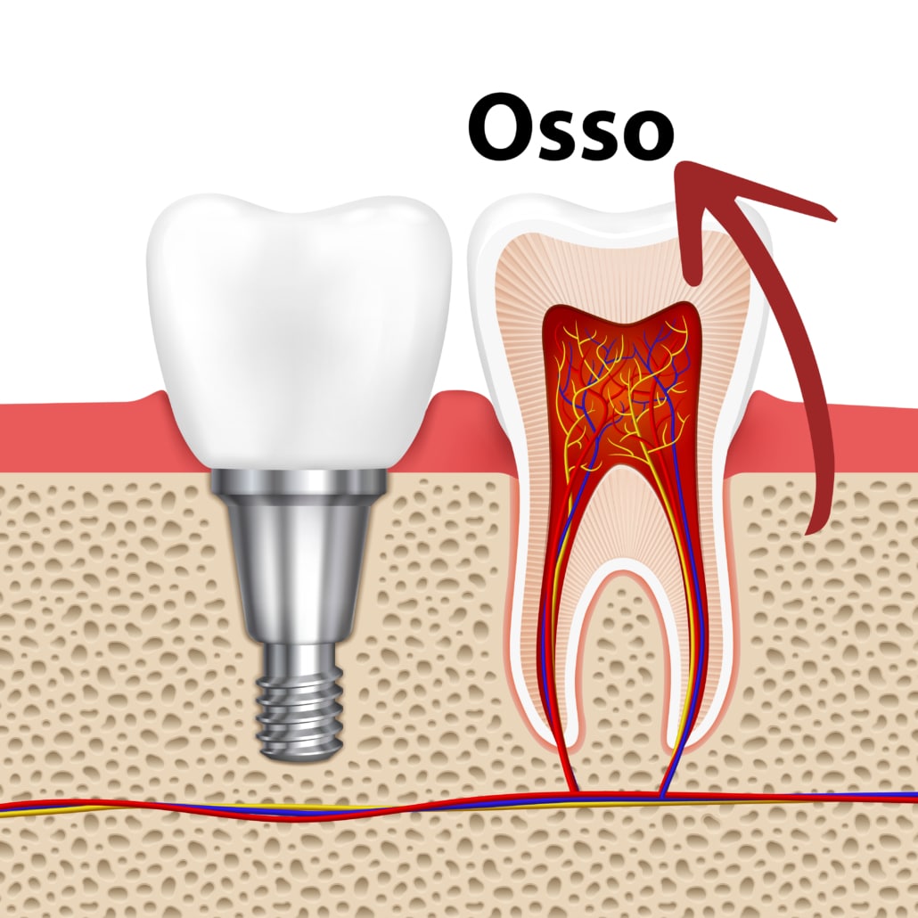 Ilustração didática comparando um dente natural com um implante dentário. Mostra o implante firmemente ancorado no osso da mandíbula graças a um enxerto ósseo, com rótulos indicando diferentes partes como 'Osso'.