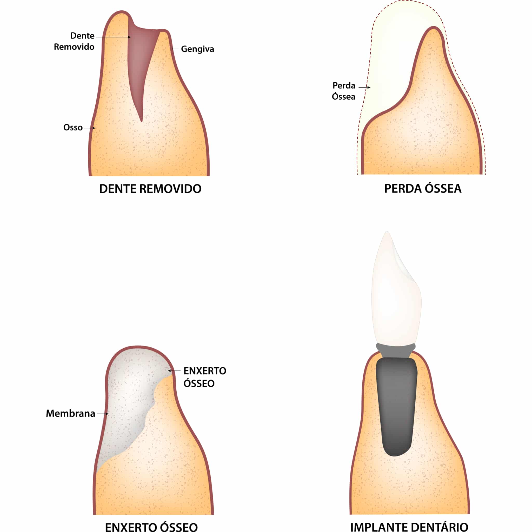 Ilustrações em sequência mostrando as etapas após a remoção de um dente, incluindo a perda óssea e o procedimento de enxerto ósseo, culminando na colocação de um implante dentário.