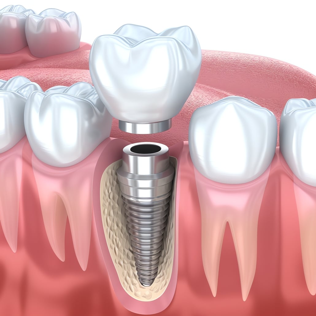 Representação gráfica detalhada de um implante dentário no lugar de um dente molar, mostrando a estrutura metálica do implante inserida na gengiva com enxerto ósseo.