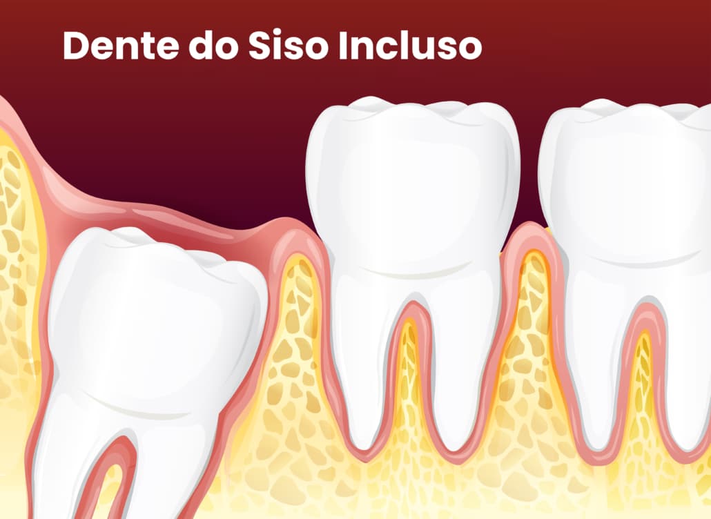 Uma ilustração mostrando um dente do siso incluso, que não conseguiu erupcionar corretamente devido à falta de espaço na arcada dentária.