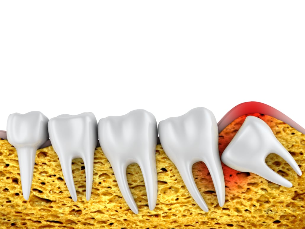 Ilustração de um dente do siso impactado, empurrando contra os dentes vizinhos e causando inflamação na gengiva. 