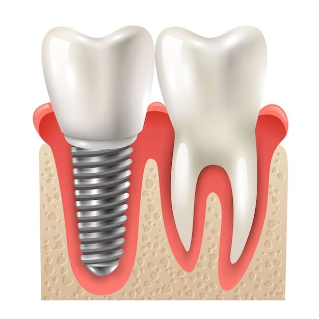 A imagem mostra um implante dentário ao lado de um dente natural na mandíbula. O implante é composto por uma base de metal que se encaixa no osso, com uma coroa dentária artificial montada no topo, que se assemelha ao dente ao lado em forma e cor.