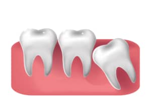 Ilustração mostrando dentes na arcada dentária, com um dente do siso visivelmente inclinado, indicando uma possível condição de impacto.