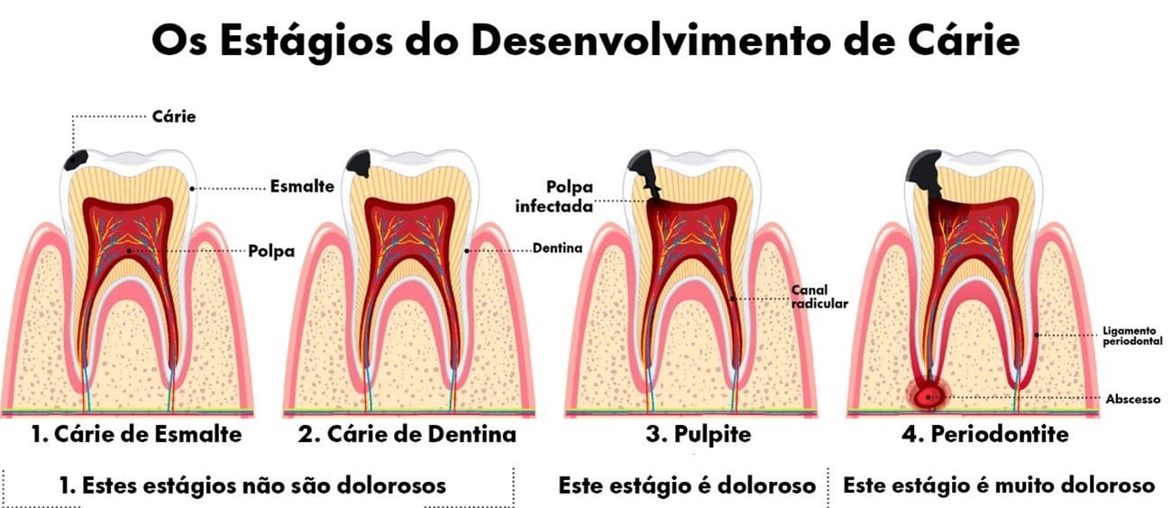 Ilustração colorida dos estágios do desenvolvimento de cárie dentária mostrando quatro fases: cárie de esmalte, cárie de dentina, pulpite e periodontite. Cada fase é detalhada com partes do dente afetadas, como esmalte, dentina, polpa e ligamento periodontal. Uma ótima ferramenta visual para entender como evitar que o problema avance e nunca mais ter cárie.