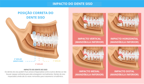 Gráfico educativo mostrando diferentes tipos de impacção dos dentes do siso na mandíbula, com detalhes claros sobre posições vertical, horizontal, mesial e distal. Essencial para entender quando é necessário avaliar o siso para tratamento ortodôntico ou remoção.