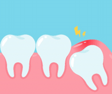 Ilustração de três dentes com o último apresentando inflamação ao redor, indicativo de problemas que podem exigir avaliar o siso para tratamento adequado e prevenção de maiores complicações.