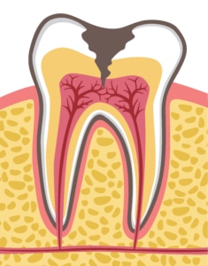 Ilustração detalhada de um corte transversal de um dente molar afetado por cárie profunda, mostrando danos à dentina e polpa. A imagem serve como um alerta visual sobre os danos causados pela cárie e a importância de cuidados preventivos para nunca mais ter cárie.