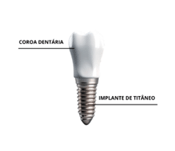 Ilustração mostrando o implante dentário e a coroa dentária.